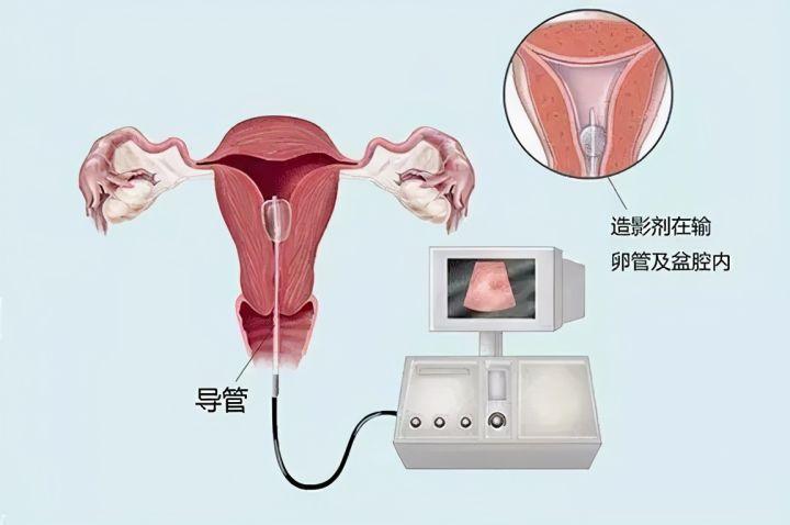 不孕女性都要做输卵管造影吗?医生这样说