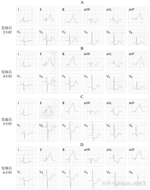 st段抬高型心肌梗死的心电图诊断