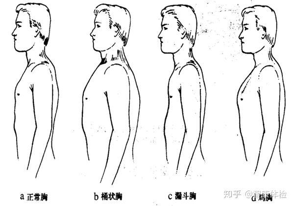 形状如算盘珠,医学上称肋骨串珠;两侧肋缘向外翻起称"肋外翻",两侧肋