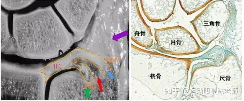 三角纤维软骨tfcc损伤该如何治疗和康复呢