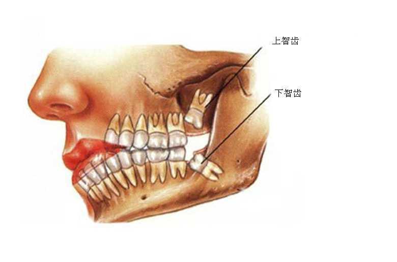 智齿是最里面的第三颗磨牙经常痛要拔吗