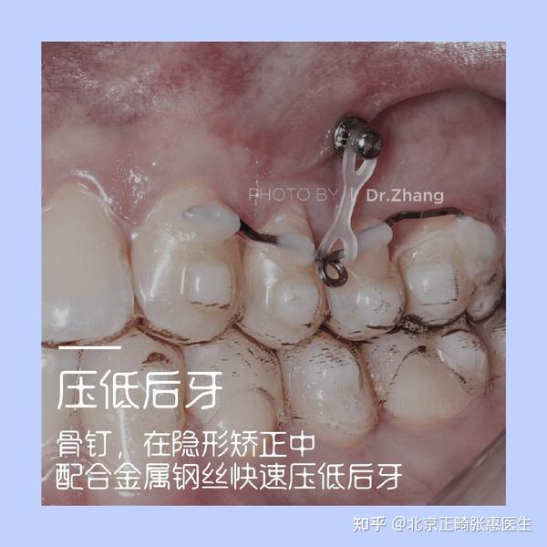 北京牙齿矫正丨正畸治疗中为什么需要使用支抗钉(骨钉)?