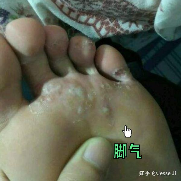脚痒痒那些小水泡到底是湿疹还是脚气