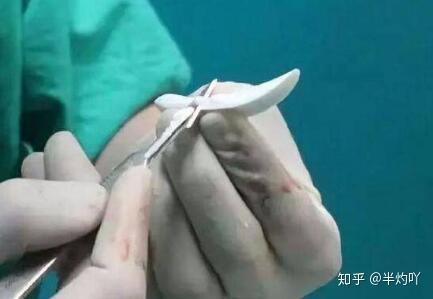 l型假体和柳叶型假体该如何选择