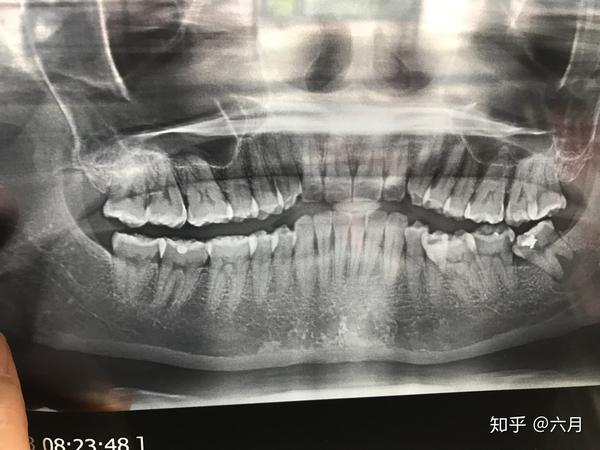 智齿下颌骨囊肿治疗全过程路漫漫