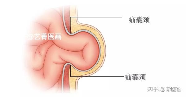 在b超检查中,疝囊颈是鉴别判断不同疝的的重要结构,而腹壁下动脉则能