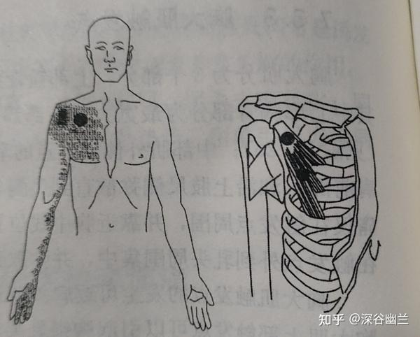 胸小肌触发点及其牵涉痛位置