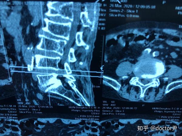腰部ct,l4/5定位图,该节段椎间盘突出很厉害