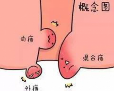 得了痔疮怎么办?