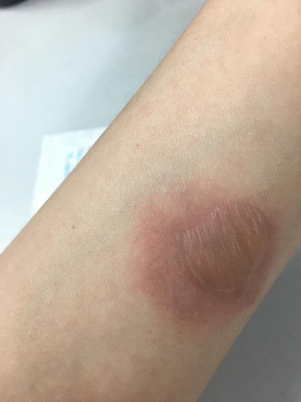 烫伤疤痕修复