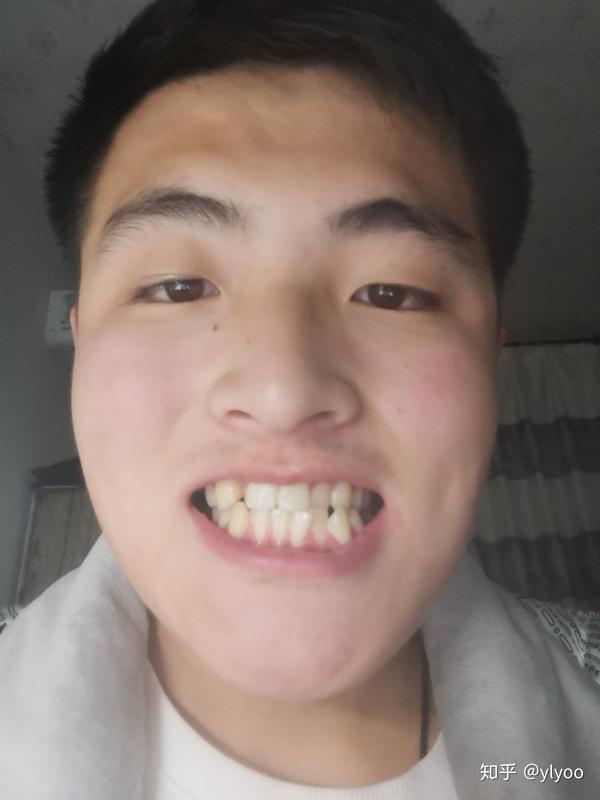 牙齿矫正对个人外貌变化有多大影响?