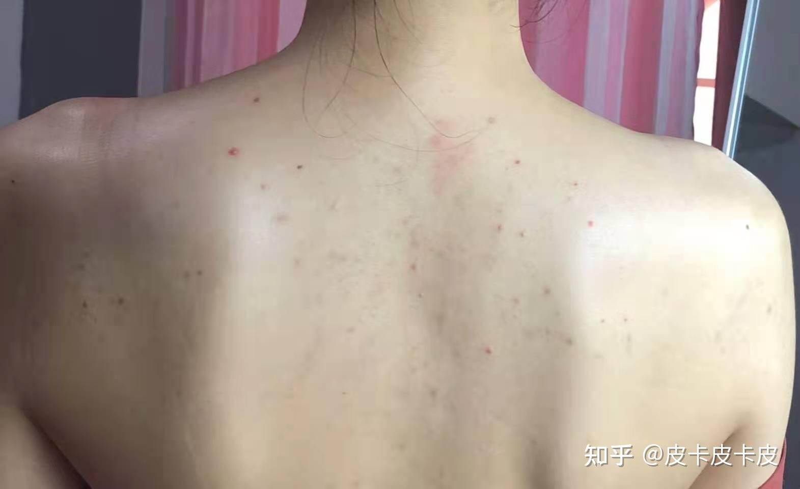 要怎么有效去除后背的痘痘和痘印