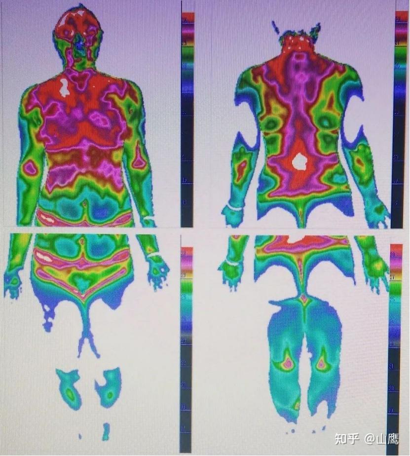 中医热ct红外热成像在治未病中的应用