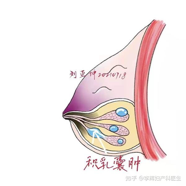 哺乳期乳房疙疙瘩瘩影响喂奶吗丨泌乳顾问日记