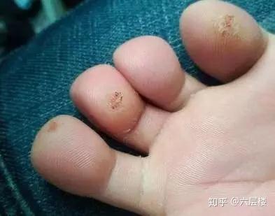 时间承受压力导致的,为 物理性皮肤疾病,形状像鸡的眼睛才得这个名字