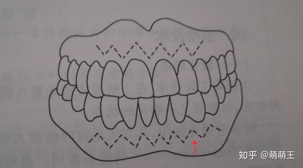 (注意:勿形成及深的凹陷)在附着龈的部位刻画.