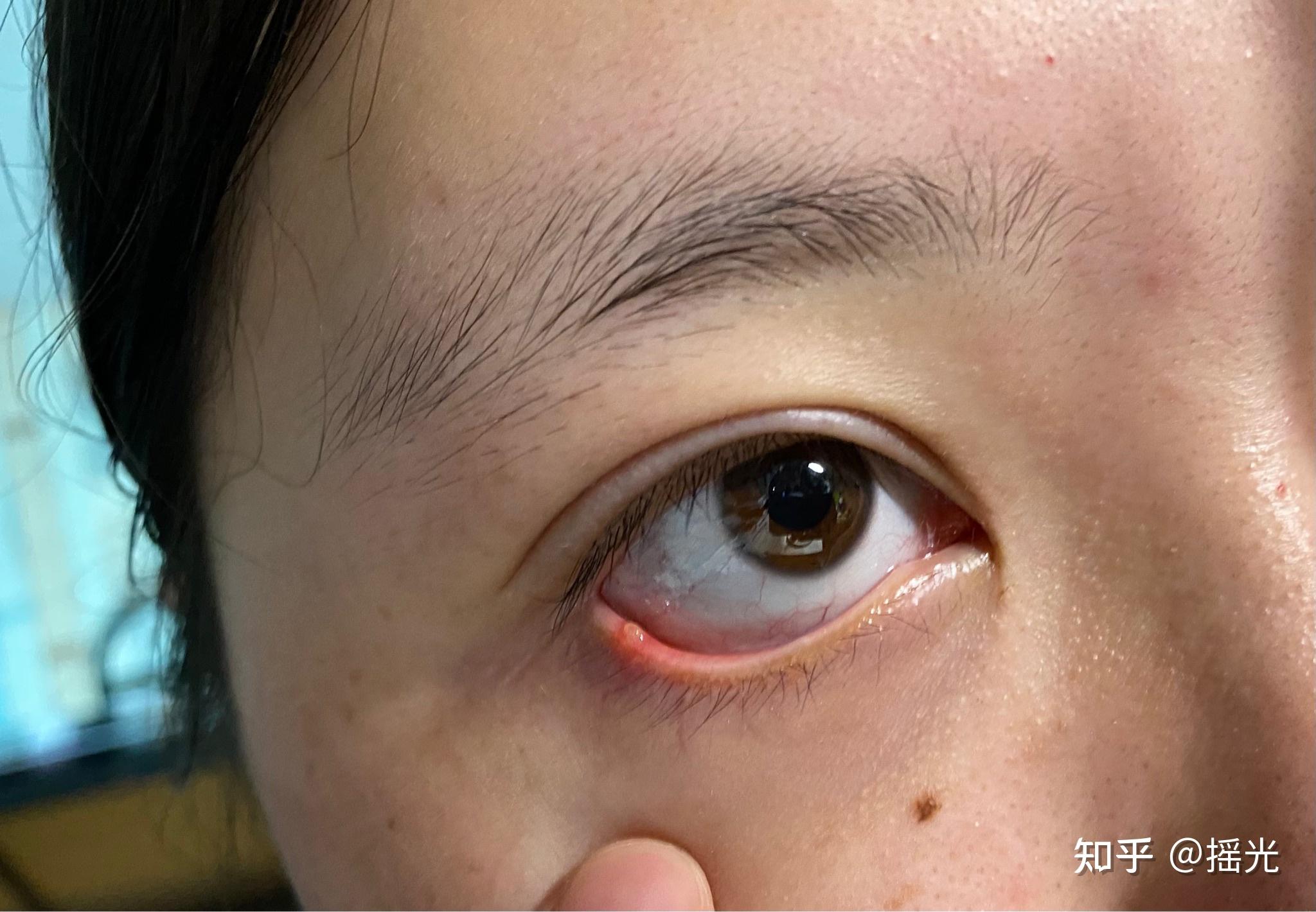 眼睑炎下眼皮里面长了透明小泡大概长了一两个月了没有消退不痛不痒