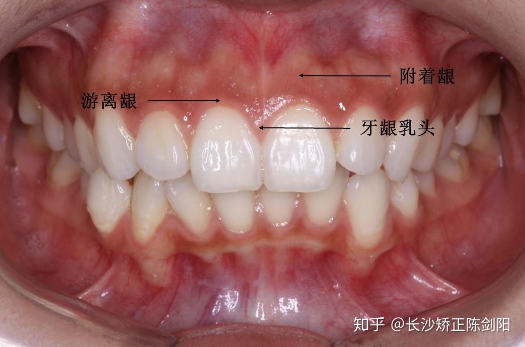 要想找到这些问题的答案,我们首先要从牙龈的解剖