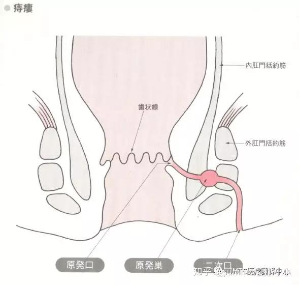 得痔疮是怎样一种体验?