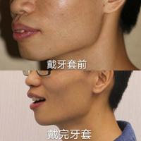 深圳程序猿25岁戴上了牙套,建议越早去戴会越好!