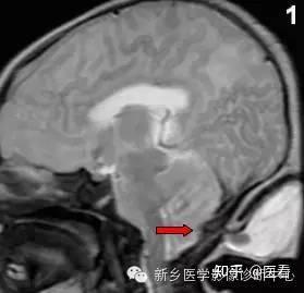 小脑扁桃体下疝畸形(chiari畸形)的分型及图解