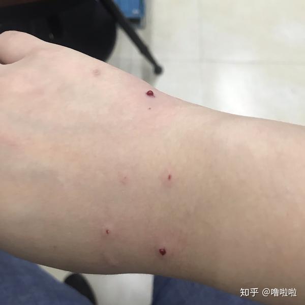 宠物美容师被猫咬伤
