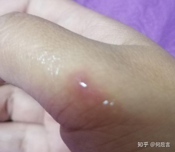 给她涂药的时候用她的边角残余涂了一个一个月前小土豆时留在手上的疤
