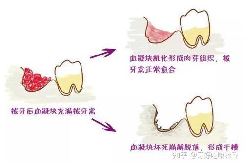干槽症:拔牙后血凝块脱落后牙槽骨就会暴露,表现出干燥的情况,这样