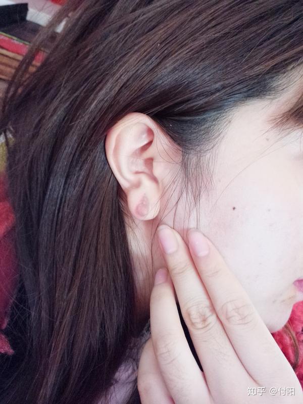 耳洞增生瘢痕疙瘩疤痕