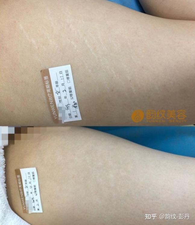 腿上有很多生长纹,该怎么消除?