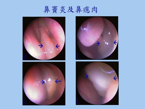 微信 bj13161307132  在线解决眼耳鼻喉疾病烦恼   鼻息肉是在鼻腔和