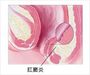 当国庆中秋遇上"肛窦炎"怎么办?