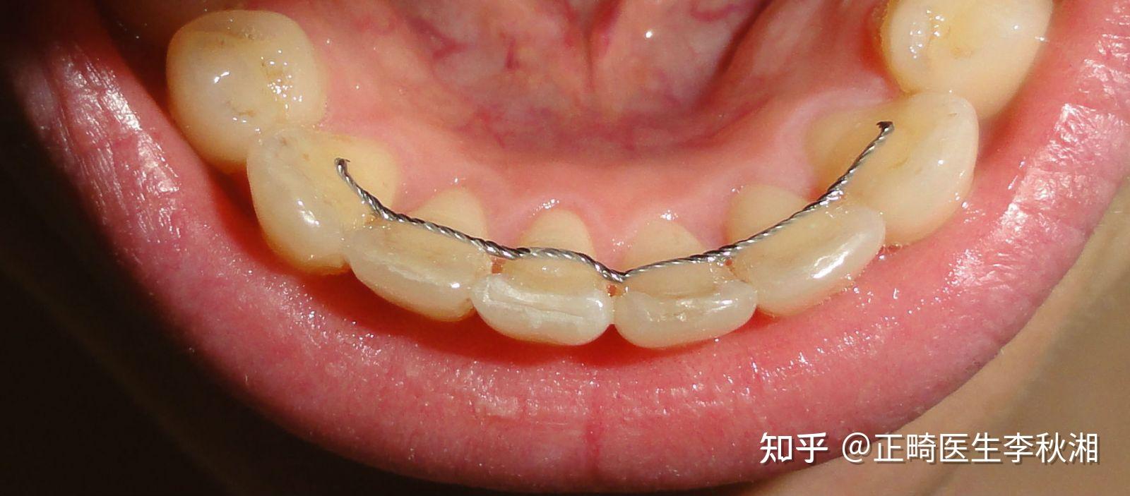 拔牙整牙不戴保持器反弹会有缝隙吗