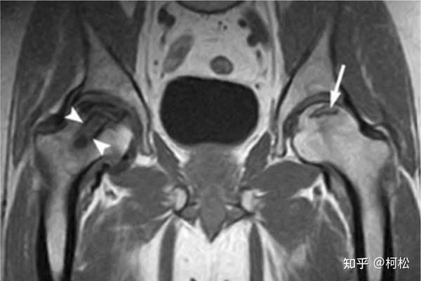 髋关节一过性骨质疏松与股骨头坏死