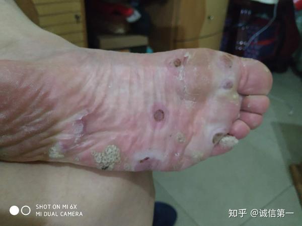 分享自己治疗跎疣的经历