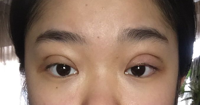 南华博士双眼皮太深切口凹陷明显如何修复