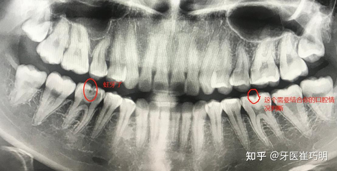 怎么通过牙片看有几颗蛀牙