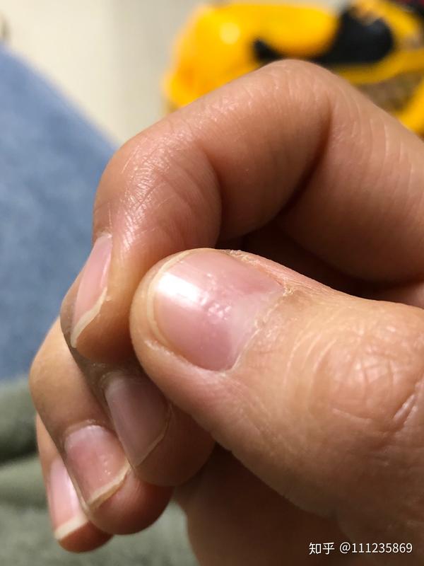指甲就这样半年了,也不知道怎么回事,表面很多凹点看上去像一条线
