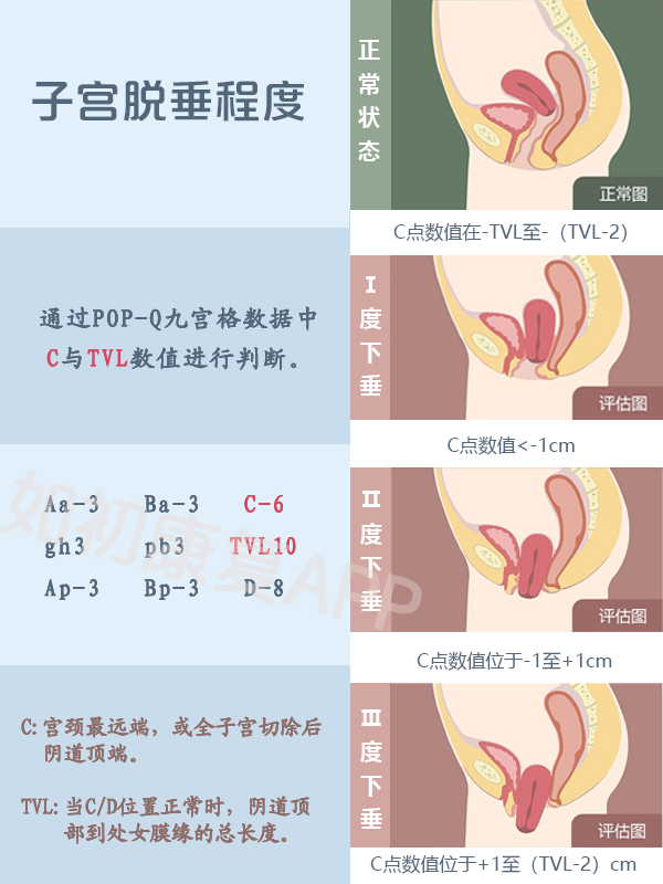 产后子宫脱垂程度&阴道壁膨出程度判断方法