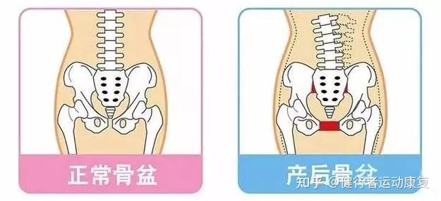 骨盆不正问题正在危害我们的身体你该了解一下自己的骨盆了