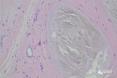 痛风以后,关节,肝肾发生了哪些病理变化?