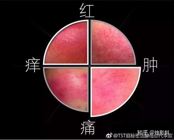 蛛网型:红血丝呈网状,可清晰看见它的丝状形态,这也是比较严重,比较