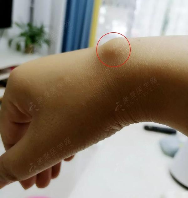 腕背长大包,这7种治疗方法哪个最好?