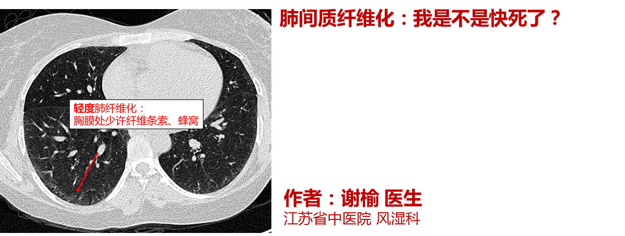 风湿病肺间质纤维化我是不是快死了