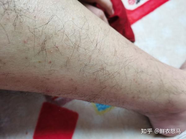 腿上起密密麻麻的红点
