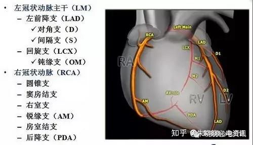 掌握这5招轻松锁定心梗罪犯血管