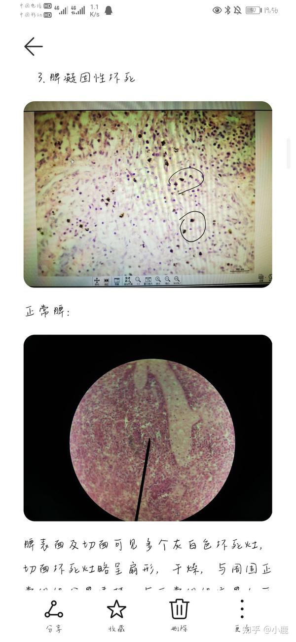 部分病理学切片红蓝铅笔手绘图,画的有一点点丑