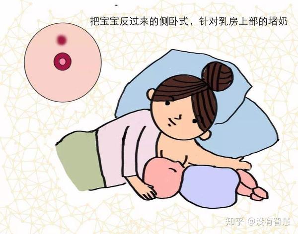 堵奶如何处理?