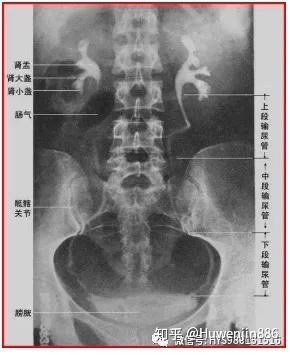 输尿管结石难以忍受之痛