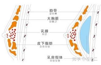 隆胸是女性为了提升个人魅力而针对乳房进行的一种增大行为,主要依靠